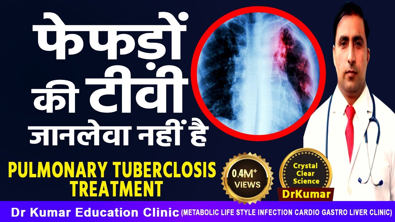 Pulmonary Tuberculosis treatment//फेफड़ों की टीवी जानलेवा नहीं है