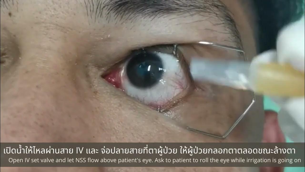 Eye irrigation YouTube
