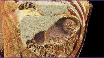 Gastric Duplication Cyst with Cinematic Rendering