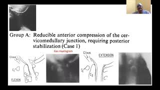 Video Journal Club 9 - Craniovertebral Anomalies - Prof Dr Sudhir Srivastava screenshot 4