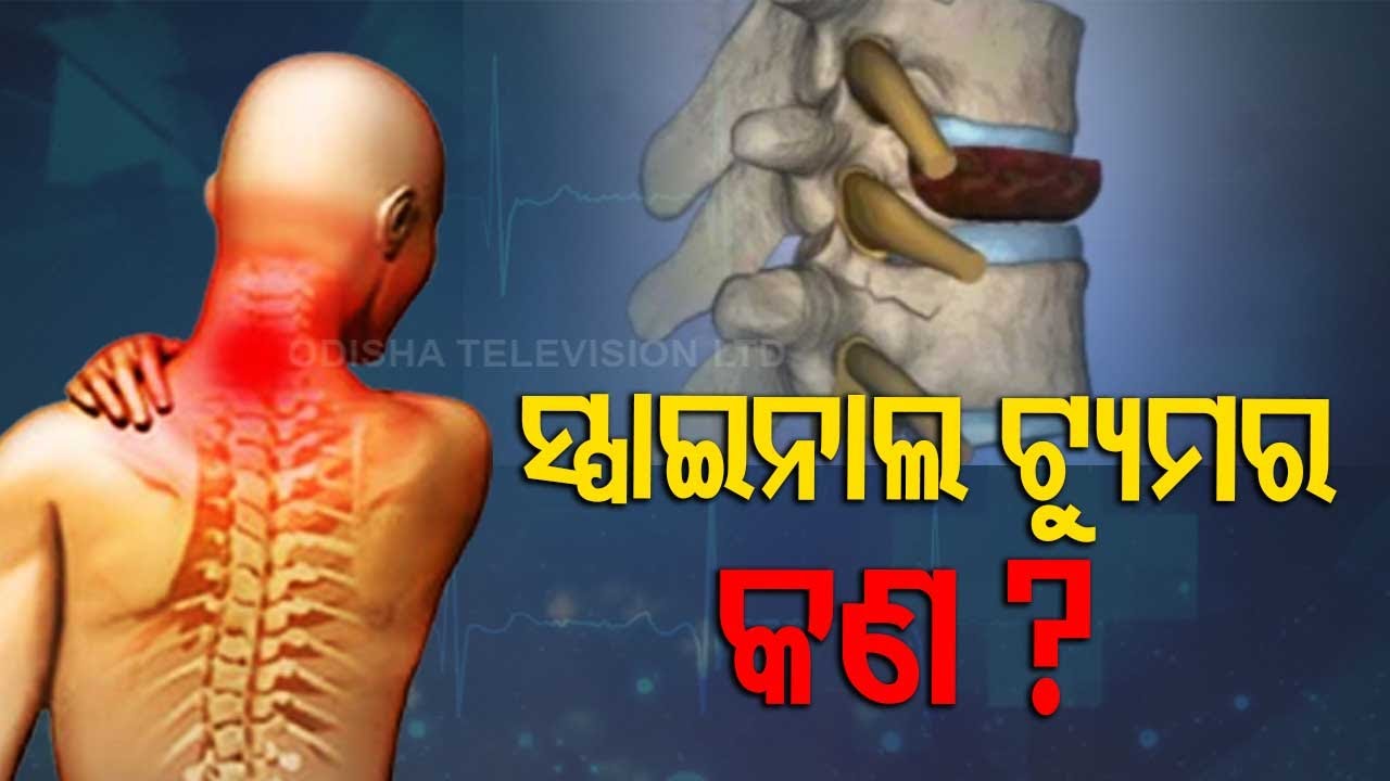 Spinal Tumour | Know Causes, Symptoms And Treatment | OTV