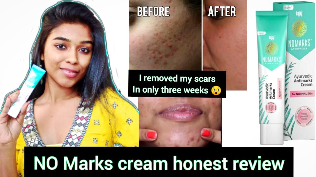 *New* Bajaj No Marks Cream for Normal Skin| Remove Acne | Dark Spots