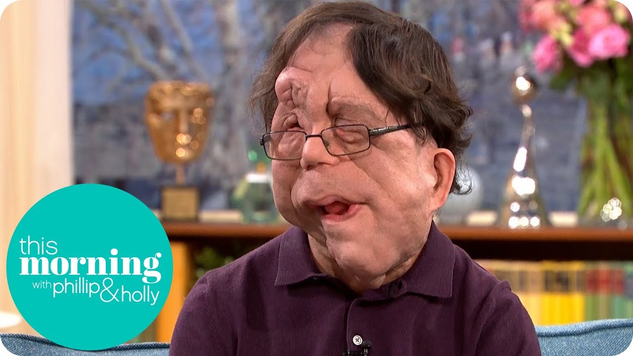 Adam Pearson On Changing Perceptions Of Disfigurement This Morning Youtube