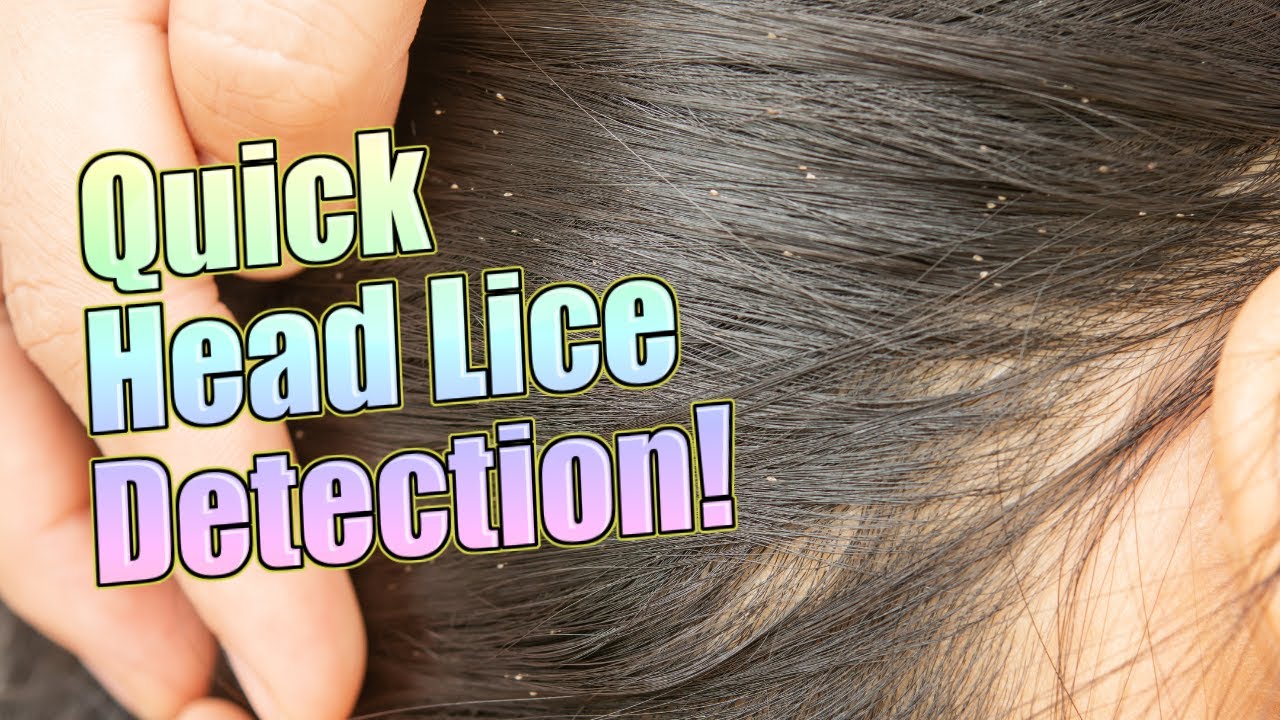 How to Check for Head Lice: The Ultimate Guide for Detecting and Preventing  Infestations - YouTube