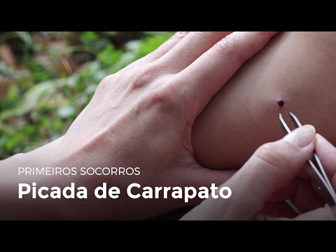 Vídeo: Uma picada de carrapato dói?