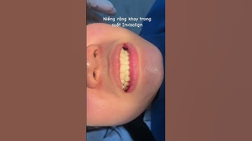 Niềng răng khay trong suốt Invisalign