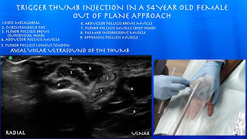 Ultrasound Guided Trigger Thumb Injection-Out of plane approach- by probeultrasound