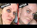 How i cured my rosacea