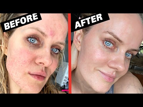 HOW I CURED MY #ROSACEA