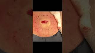 A Very Unusual Mango-Colored Lipoma