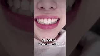 Smile transformation!