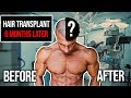 Hair Transplant Results After 6 Months | Before & After