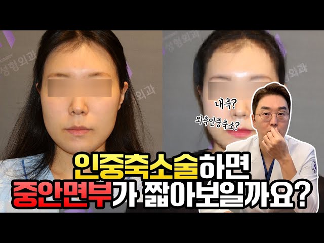 중안면부가 긴얼굴은 인중축소수술 하면 짧아보일까요?