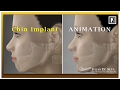 Chin Implant Animation Video - How is a chin implant inserted?