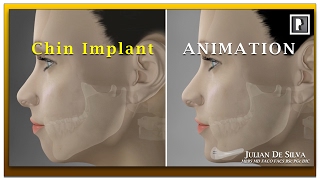 Chin Implant Animation Video - How is a chin implant inserted?