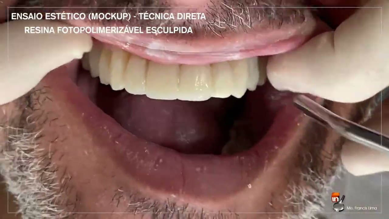 ENSAIO ESTÉTICO (MOCKUP) - TÉCNICA DIRETA DA RESINA FOTOPOLIMERIZÁVEL ESCULPIDA