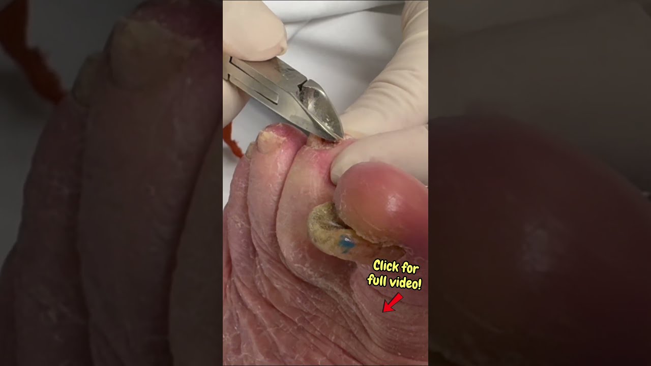 Watch This Thick Toenail SNAP Off Satisfyingshorts Satisfying Nailcutting