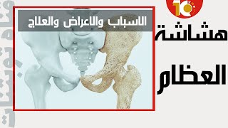 انواع هشاشه العظام | طرق الوقاية من هشاشة العظام - هشاشه العظام اسبابه وعلاجه فوائدهشاشه_العظام