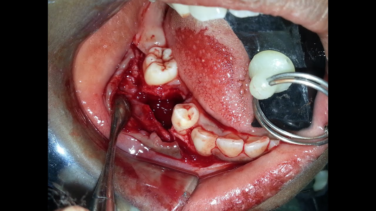 Double Surgical Management of Maxillary & Mandibular 