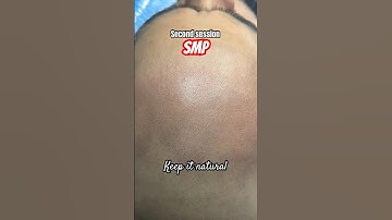 Scalp micropigmentation first and second session, India 🇮🇳 #scalpmicropigmentationindia #smp