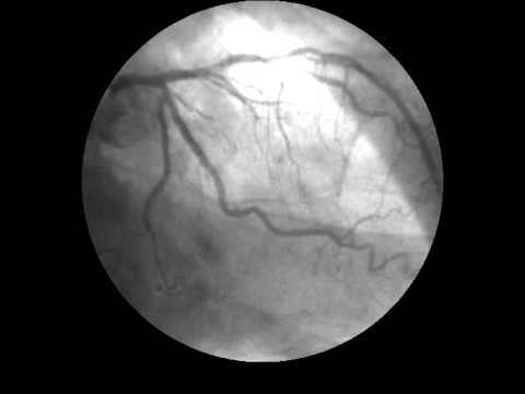 Angiogram at Cardinal Santos Hospital