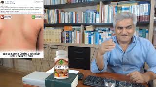 Kronik Ürtiker Nedir? Kaşınma Sebepleri Nelerdir? Nasıl Engellenir?