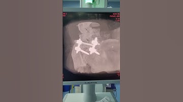 L5 S1 MIS TLIF 3D navigation guided#navigation #roboticsurgeon #minimallyinvasivespinesurgery