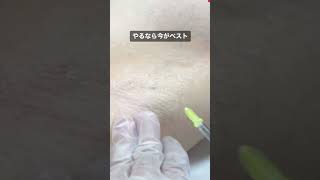 【脇汗止まる】脇ボトックスは…夏前の今がベスト！