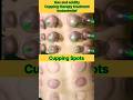 cupping therapy #TherapistworldclubDoctor #Dr.opsingh_acupointsHajipur #foryou #cuppingtherapy