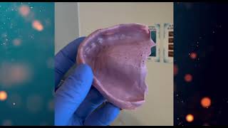 Immediate Denture to Permanent Denture Conversion