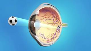 Cataract Phaco with Accommodative Lens Spanish