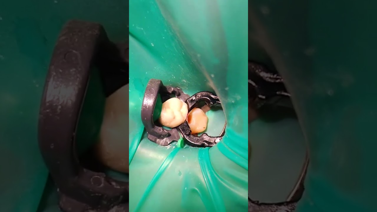 Single isolation 17 tooth.