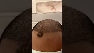 تقشير الشعر بعد 7 أيام من زراعة الشعر بإستخدام تقنية FUE وقلم سفير  |  افضل مركز زراعة الشعر في مصر