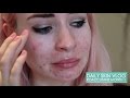 Roaccutane Daily Skin Vlog - Month 1