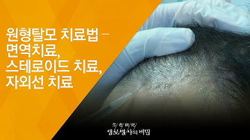 원형탈모 치료법 – 면역치료, 스테로이드 치료, 자외선 치료 - (20180801_657회 방송) 毛자람에 대하여