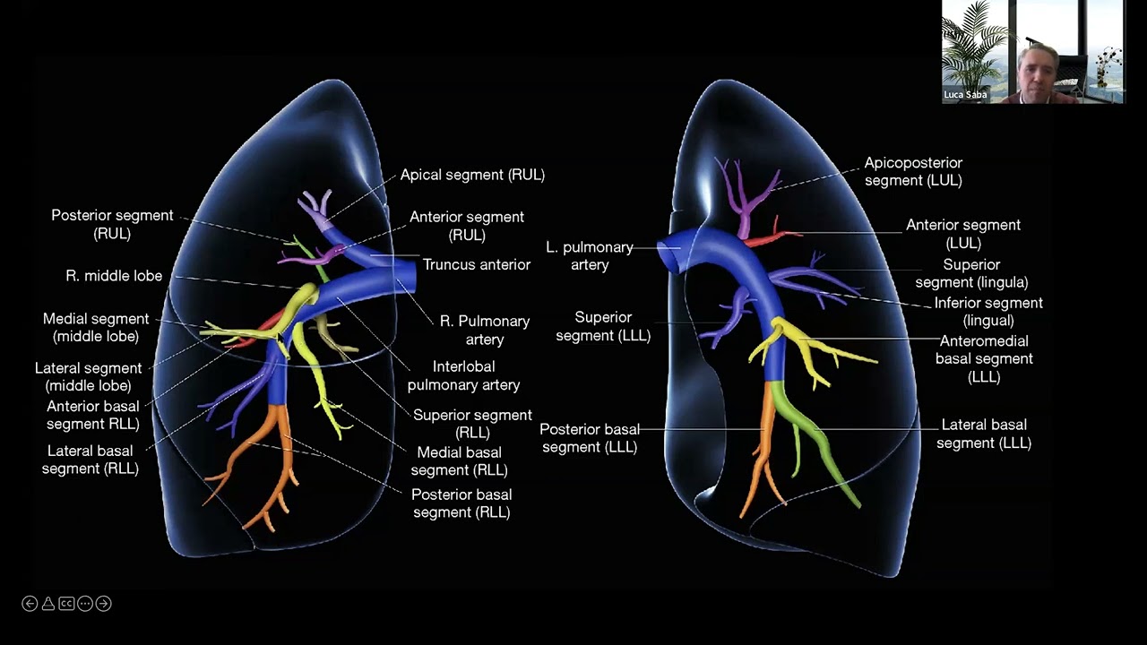 22.10) L'embolia polmonare - Prof. Luca Saba