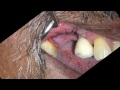 Oroantral Sinus Repair