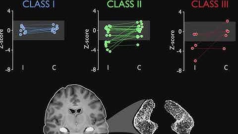 OHBM 2018 | Oral Session | Ral Rodrguez Cruces | Multidimensional cognitive subtyping in temporal …