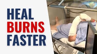 Heal Burns Faster With Hyperbaric Oxygen Therapy