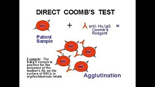 Direct Coomb Test /DCT/Positive/coomb test