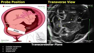 Fetal Brain Ultrasound Probe Position & Scanning Technique | TAS Axial, Coronal & Sagittal Planes