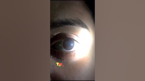 How to assess Anterior chamber depth clinically? #clinical #optom #opthalmology #eyes #optometrists