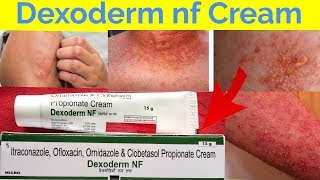 Dexoderm Nf Cream /हर प्रकार की एलर्जी को सिर्फ 3 दिन में जड़ से खत्म करें Full Review In Hindi