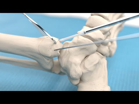 Medial malleolar osteotomy and talar osteochondral fragment fixation using bioabsorbable screw - video from Inion