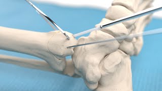 Medial malleolar osteotomy and talar osteochondral fragment fixation using Inion CompressOn™ screw