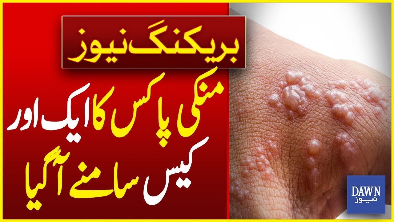 Another Monkeypox Case Confirmed in Pakistan | Breaking News | Dawn ...