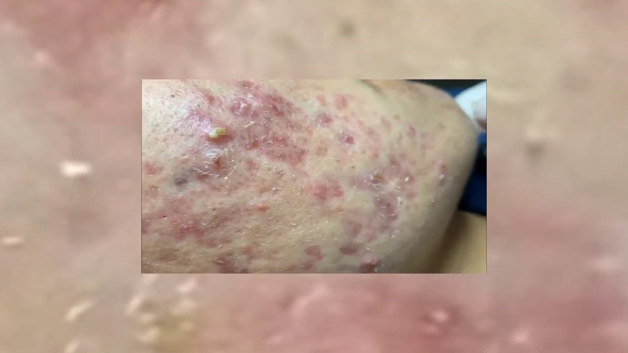 Stubborn Blackhead Treatment Satisfying Video Face Skin Care At Home