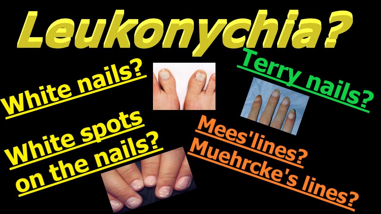 All about Leukonychia/ whitening of the nails YouTube