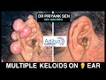 MULTIPLE KELOIDS ON EAR 👂 कान पर होने वाला केलोईड । TREATMENT BY DR PRIYANK SEN | skin specialist