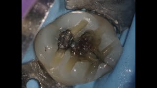 Endodontic treatment workflow - a step by step discussion of a clinical case.  How to use TruNatomy.